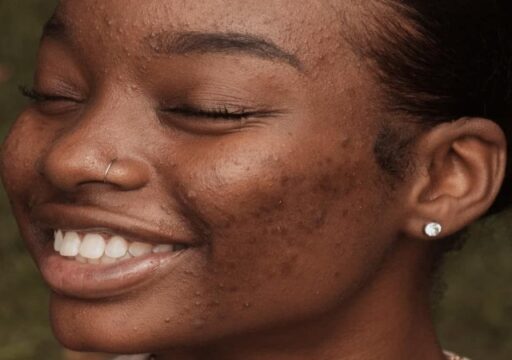 Skincare: 7 Ways To Deal With Skin Breakouts - Potentash Africa