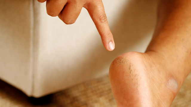 How to Heal Cracked Heels and Feet